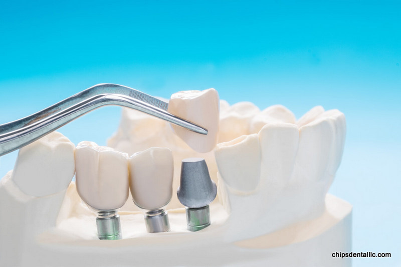 Dental Insurance That Covers Implants