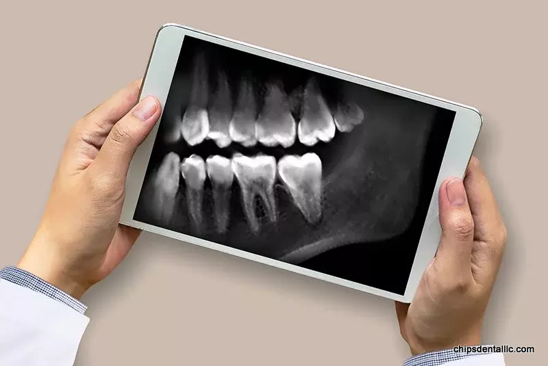 How Much Dental X-Rays Cost Without Insurance